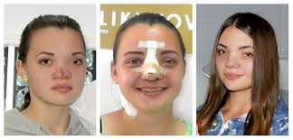 Коррекция формы носа, пластика носа от лучшего украинского хирурга